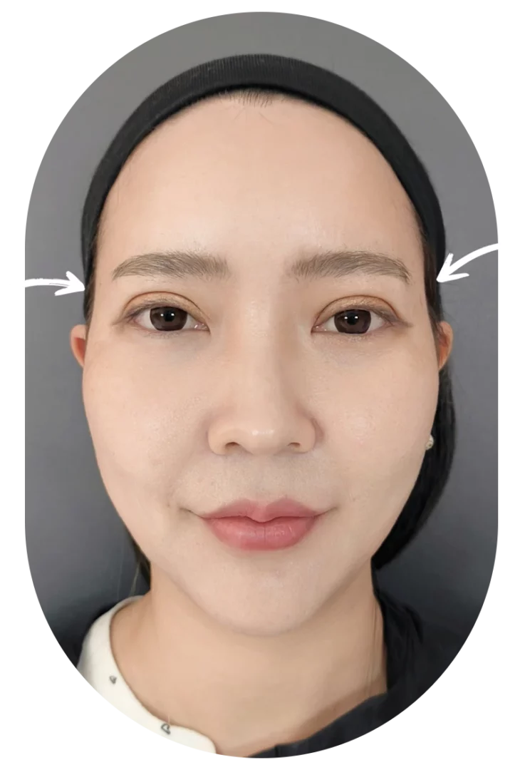 Temple filler guide: close frontal portrait of woman highlighting temples