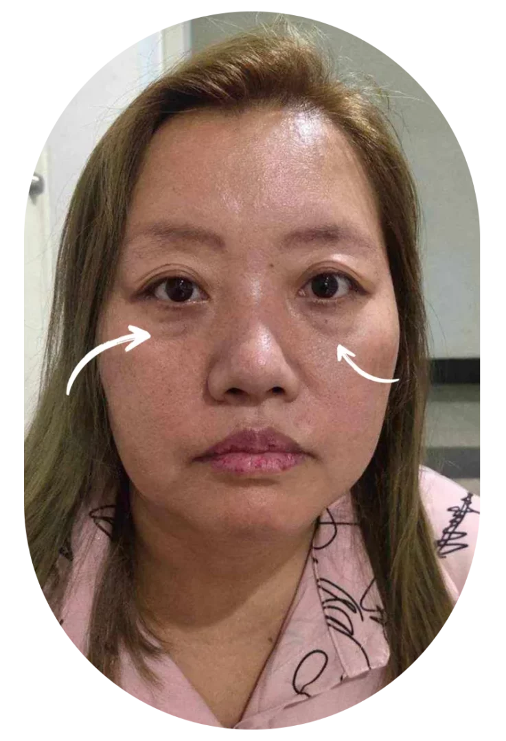 Under-eye filler before photo — woman with tear trough hollows and dark circles