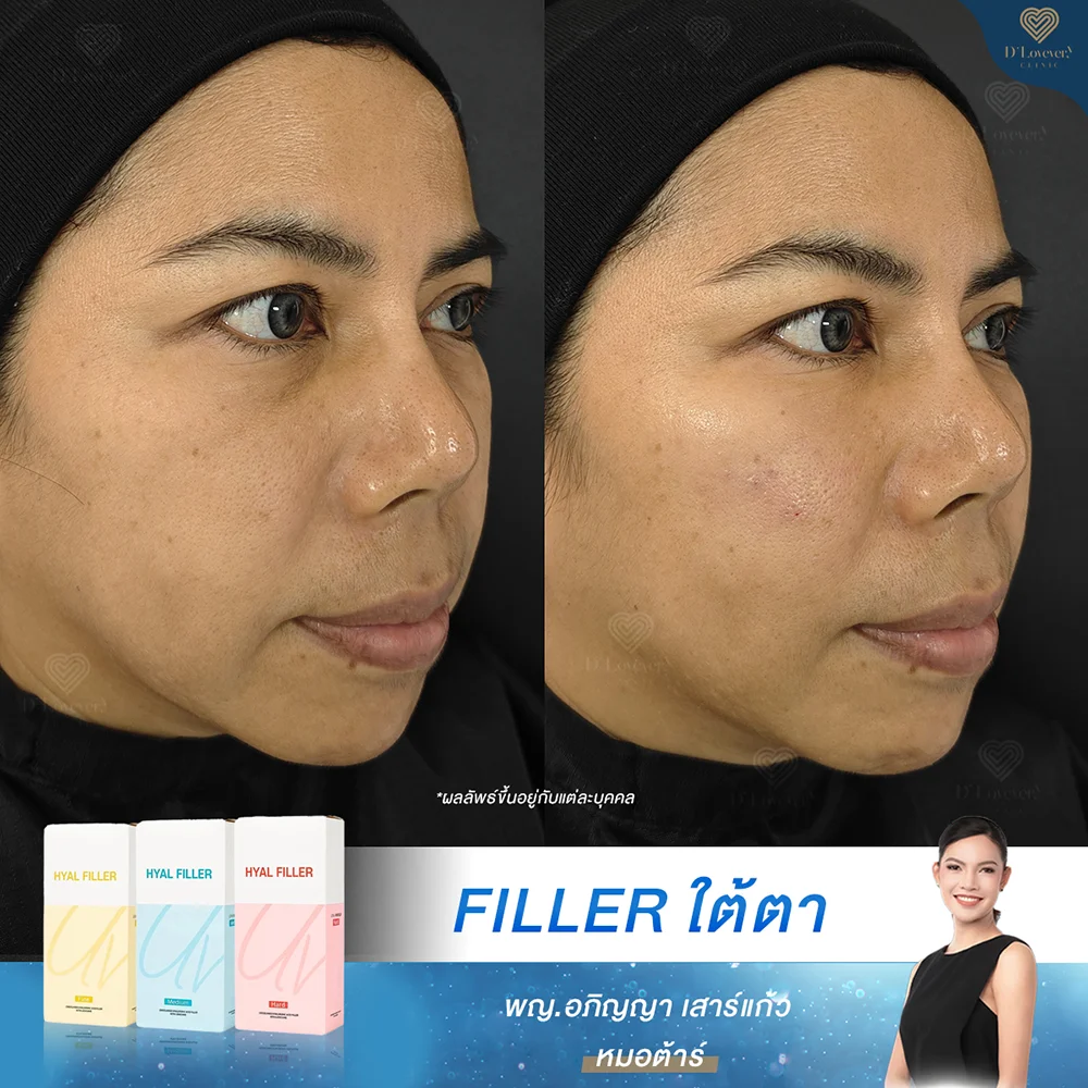 Under-eye filler before and after results: smoother, brighter tear troughs