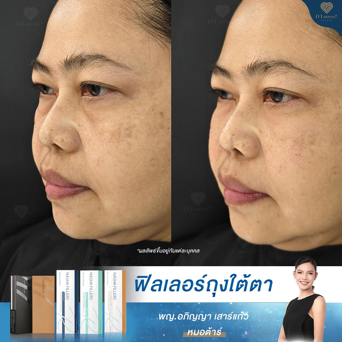 Under-eye filler before and after: tear trough correction with reduced hollows