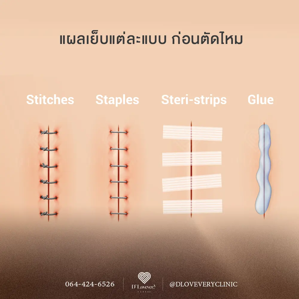 Wound closure methods: stitches, staples, Steri-Strips, tissue glue