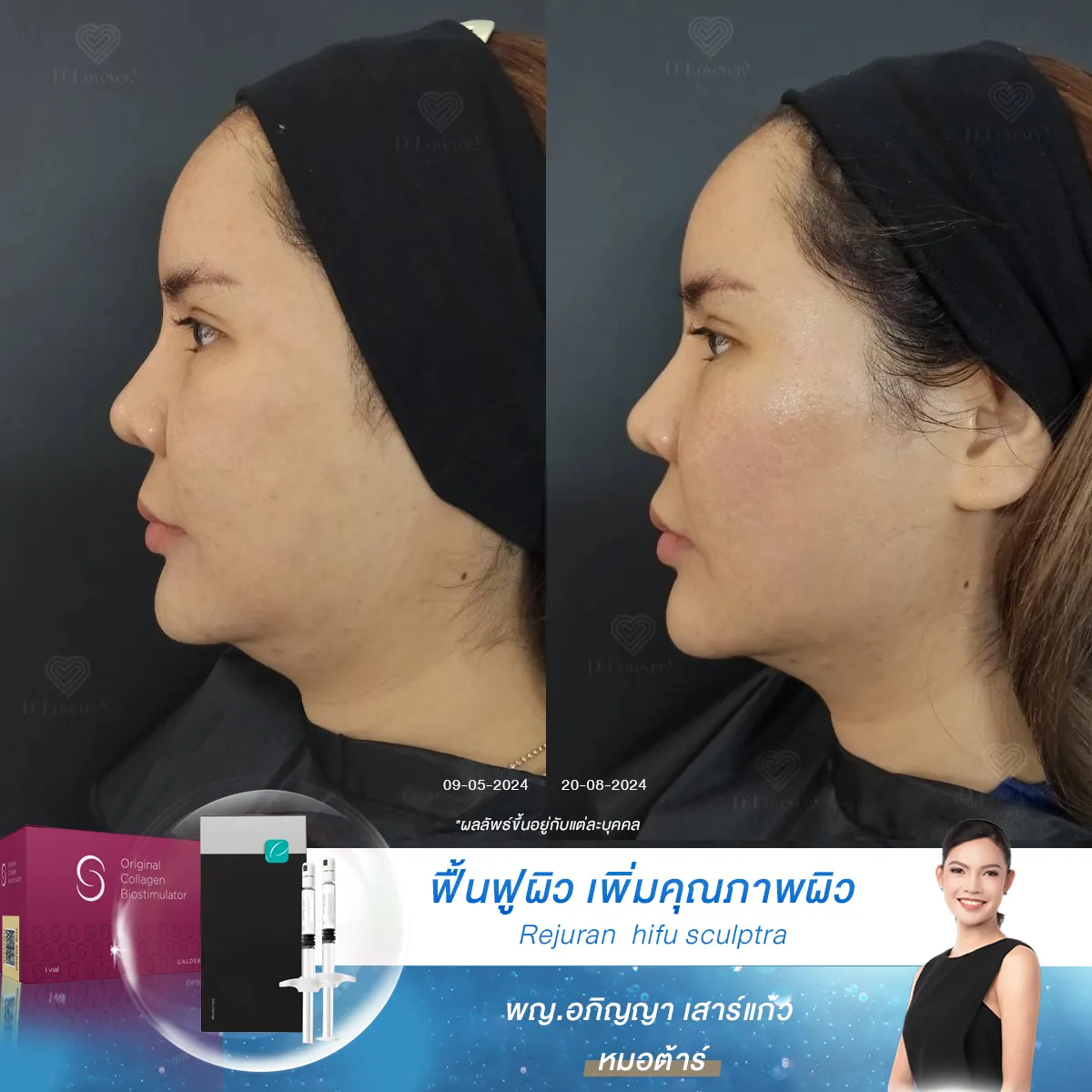 [รีวิวฉีดหน้า] กับโปรแกรม 3 ตัวตึง ฟื้นฟูผิว Rejuran  hifu sculptra