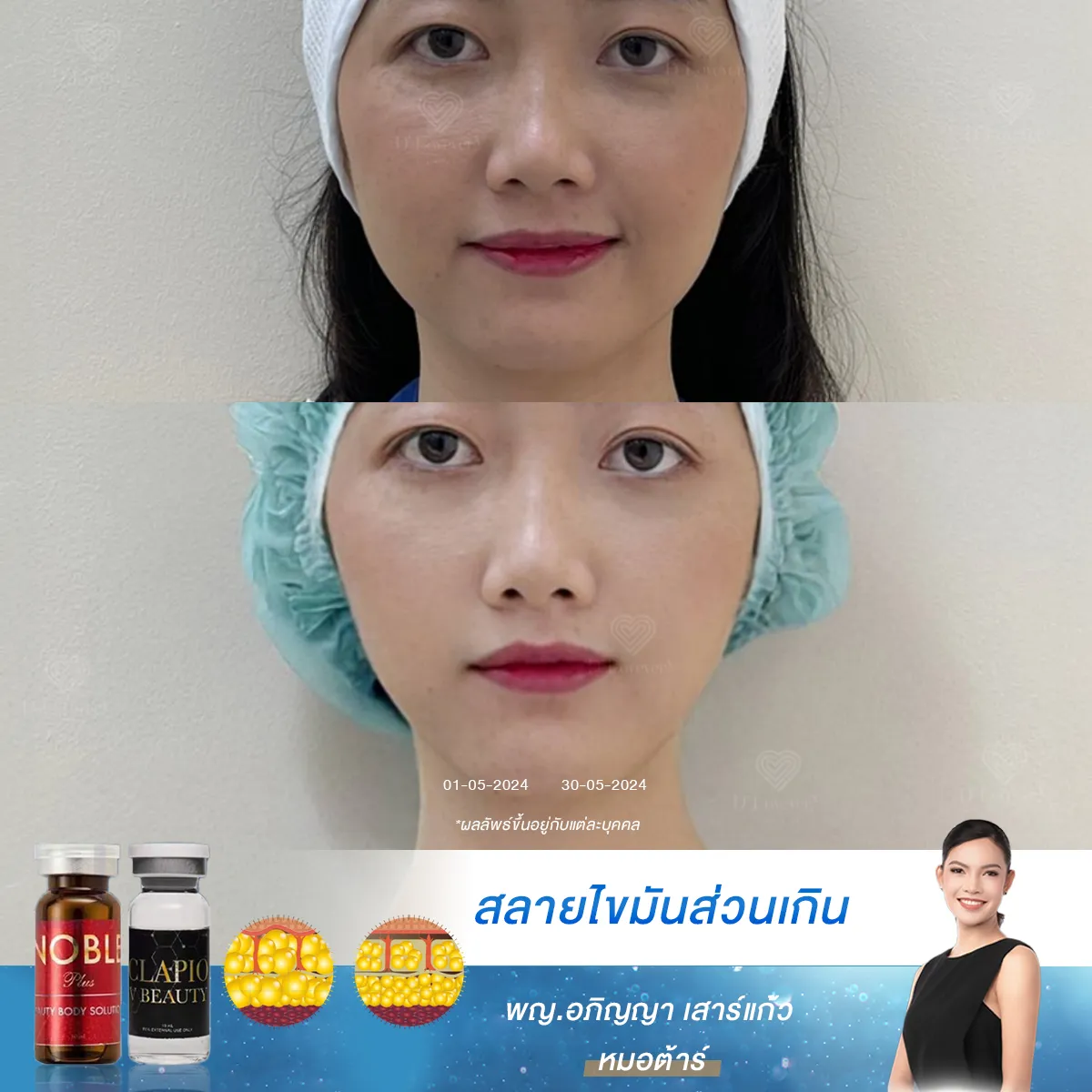 [รีวิวฉีดแฟต] ช่วยให้ตัดสินใจเรื่องการฉีดแฟต หมอจริงใจบอกหมดว่าเคสแบบไหนฉีดแฟตแล้วจะไม่เห็นผล