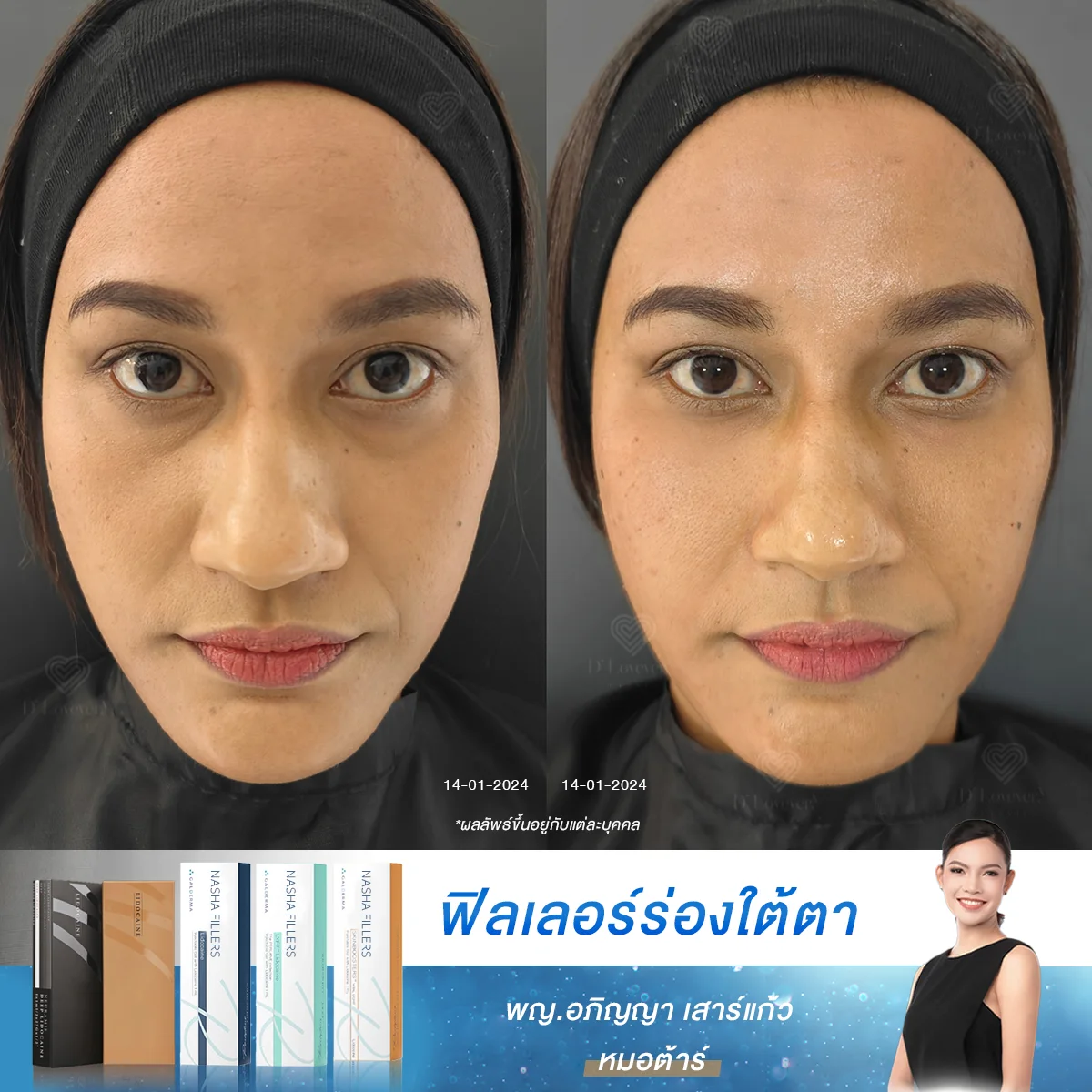 [รีวิวเติมใต้ตาชัดๆ] เรียกว่ารีวิวเปิดใจ ครั้งแรกกับฟิลเลอร์แก้ไขใต้ตาคล้ำลึก ดีจริงไหม หาคำตอบในเคสนี้ได้เลย?