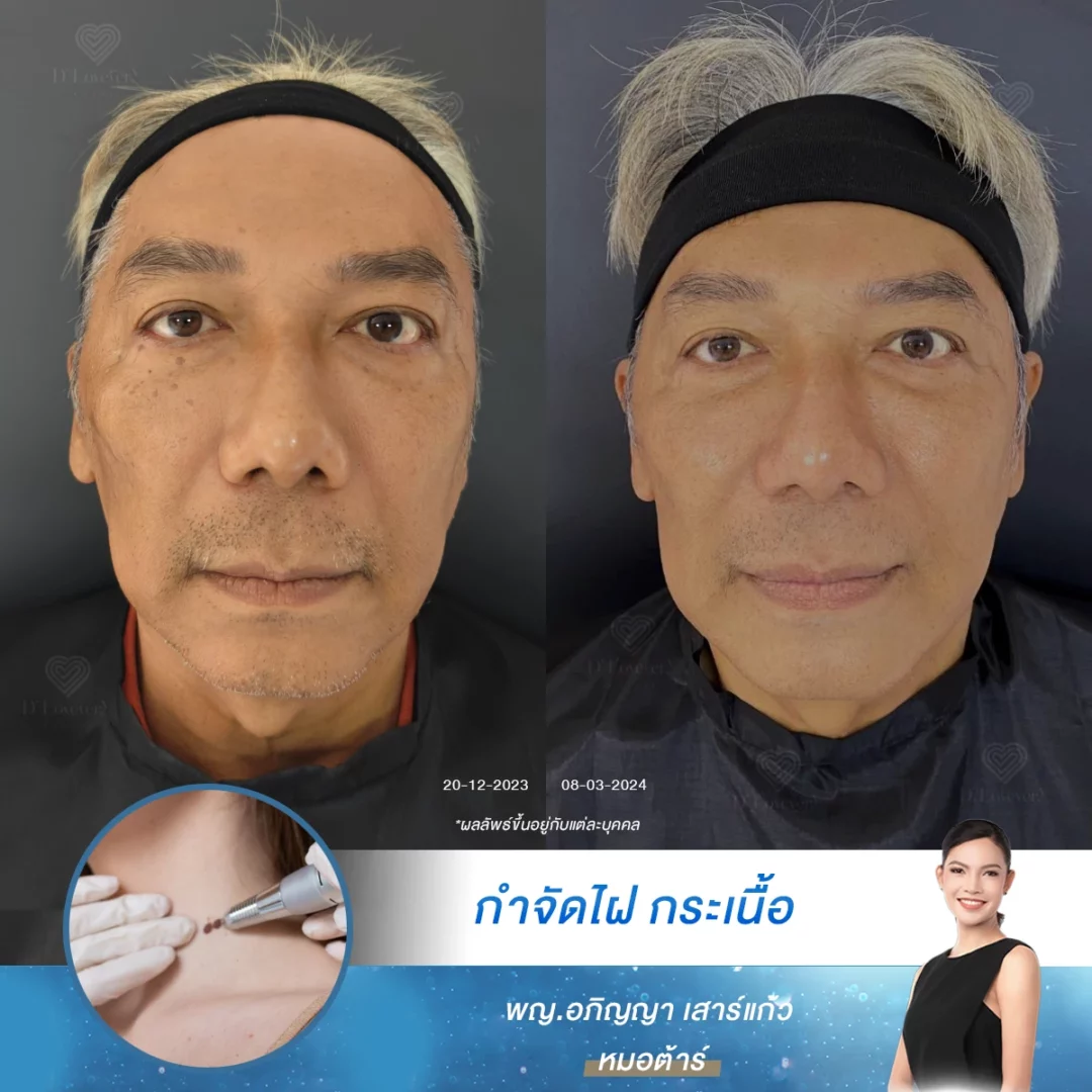 CO2 laser age spot removal before and after — smoother, brighter skin