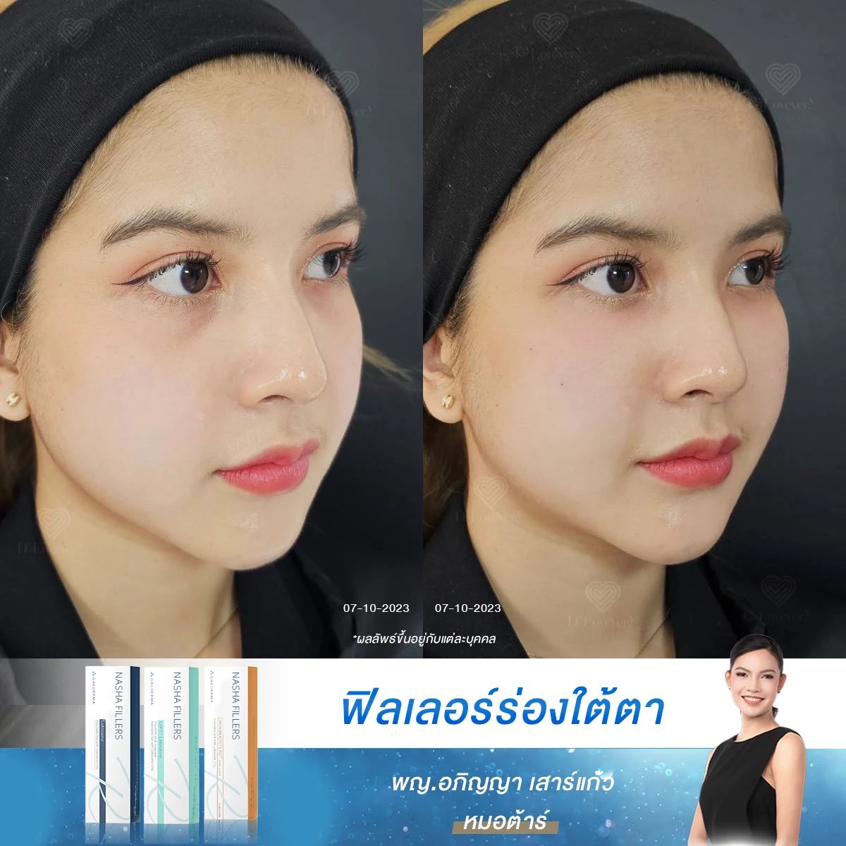 [รีวิวฉีดฟิลเลอร์] ใต้ตาไม่ต้องลึก ก็คล้ำได้ เปลี่ยนลุคให้สดใส สมวัย ที่ D’Lovevery Clinic