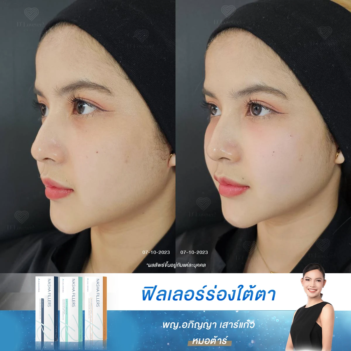 ชีวิตจะมีพลัง เมื่อใต้ตาไม่ดำ! รีวิวฉีดฟิลเลอร์ใต้ตาสายวัยรุ่น เปลี่ยนลุคโทรมให้สดใส