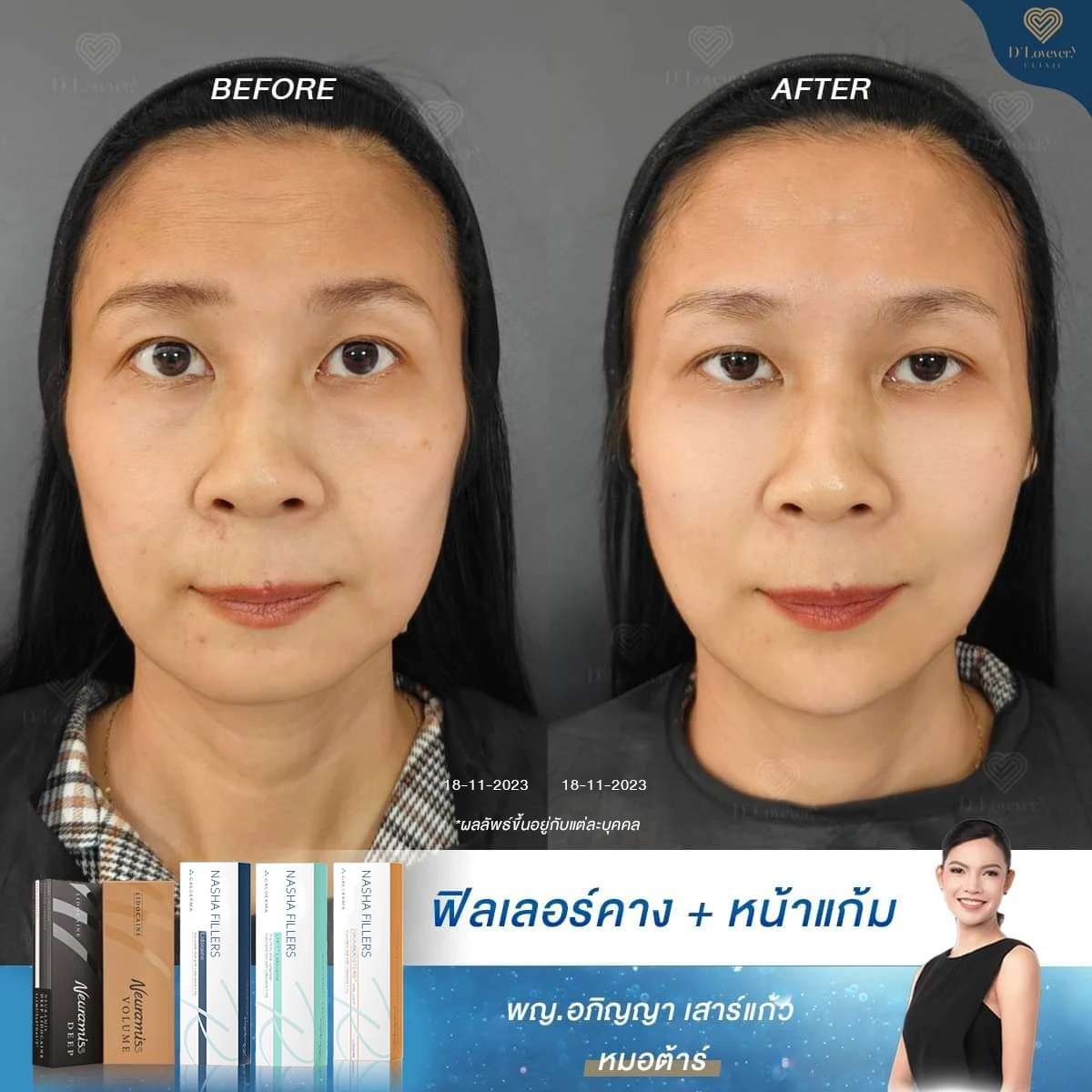 [รีวิวฉีดฟิลเลอร์คาง] คางเอียง หน้าแก้มแฟบ ต้องแก้ยังไง? รีวิวนี้มีคำตอบให้ D’Lovevery Clinic