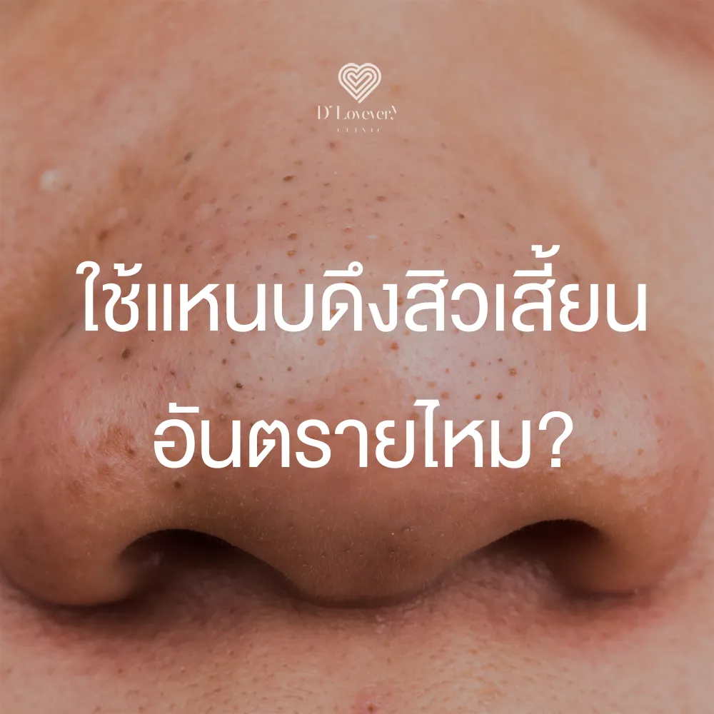 Close-up nose with blackheads; asks: Is tweezing blackheads dangerous?