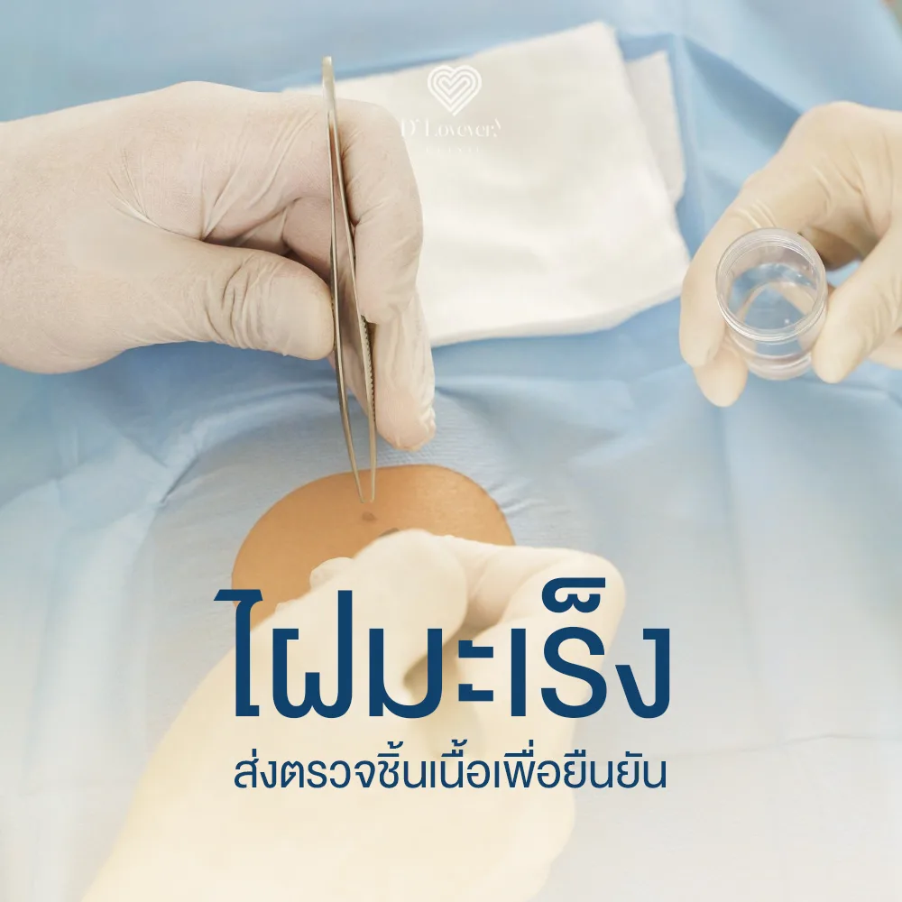 Mole biopsy for skin cancer diagnosis: gloved hands collecting tissue sample