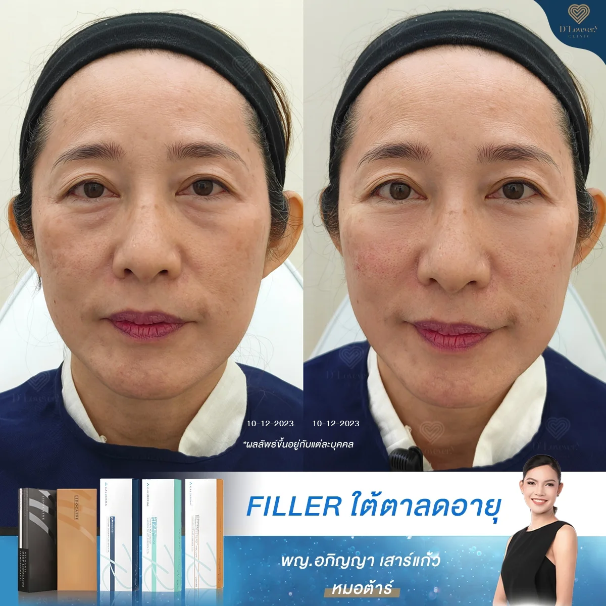 [รีวิวฉีดฟิลเลอร์ใต้ตา] เลือกคลินิกไกลบ้าน! เพราะแถวบ้านไว้ใจไม่ได้ คนไข้บ่น นึกว่าทุกที่ฉีดฟิลเลอร์ได้หมด