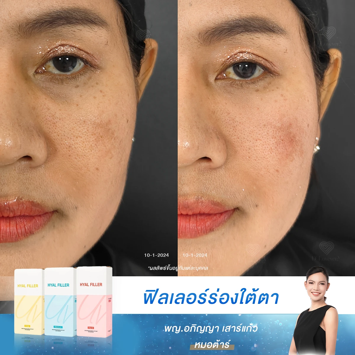 ใต้ตาหมองคล้ำ หน้าดูอ่อนล้า แก้จบด้วยฟิลเลอร์! เปลี่ยนลุคให้สดใสในวันเดียวที่ D’Lovevery Clinic