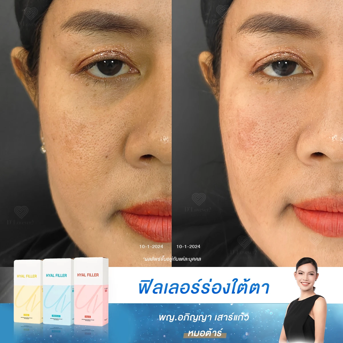 [รีวิวฉีดฟิลเลอร์ใต้ตา] อยู่กับไฟ อยู่กับกล้อง ไลฟ์สด ใต้ตาจะดูพร่องไม่ได้ ต้องรีบมาจัดการ
