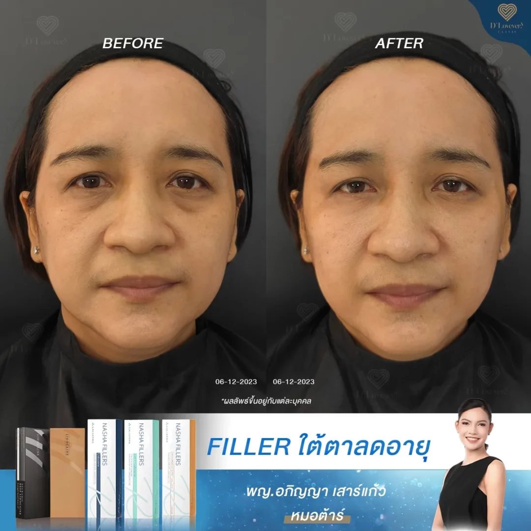 ใครเจอปัญหาใต้ตาคล้ำ หน้าโทรม ต้องอ่าน! ประสบการณ์ฟิลเลอร์จากคนจริง