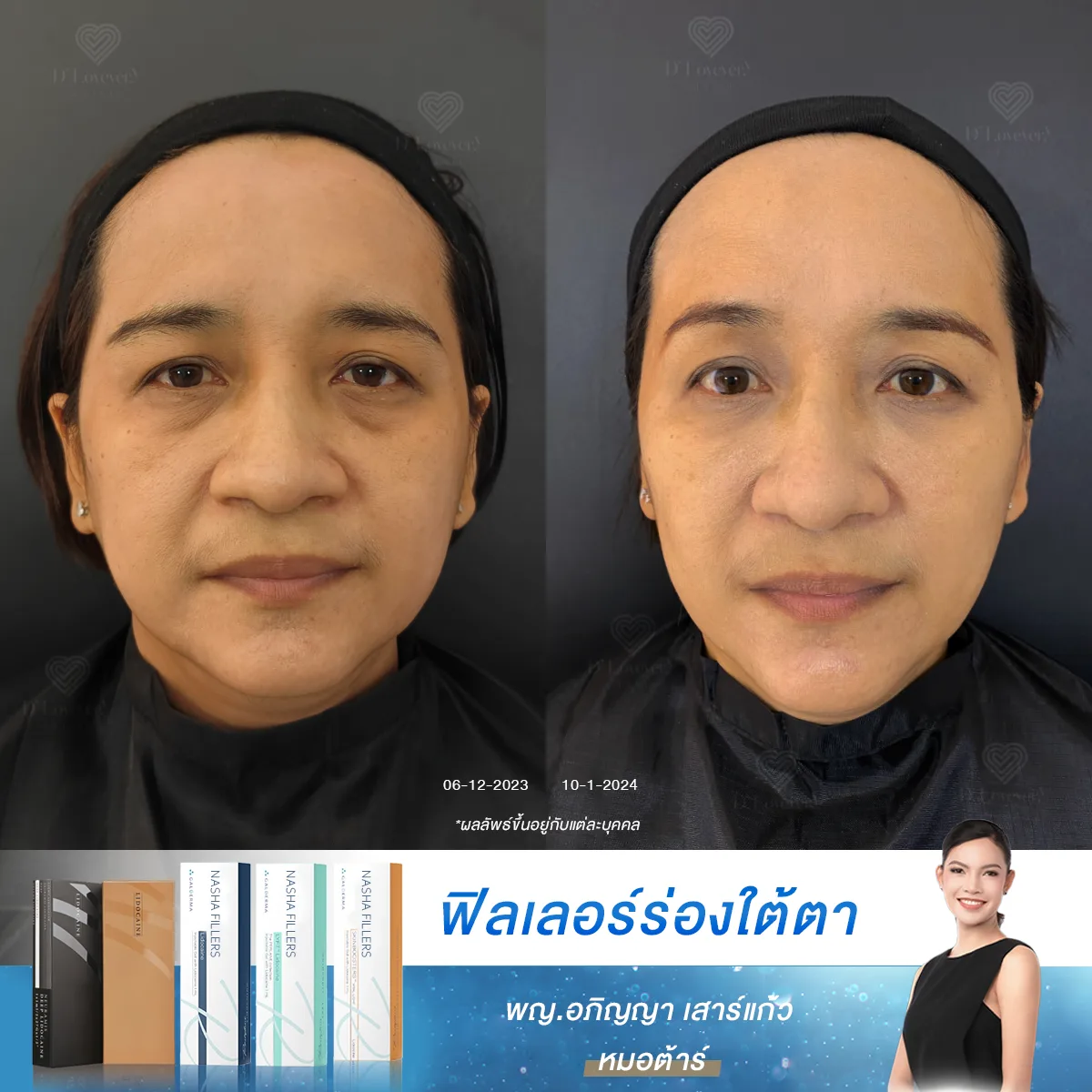 [รีวิวฉีดใต้ตาลึก] ตัดสินใจอยู่นานนะกว่าจะเลือกคลินิกสำหรับฉีดฟิลเลอร์ใต้ตาได้