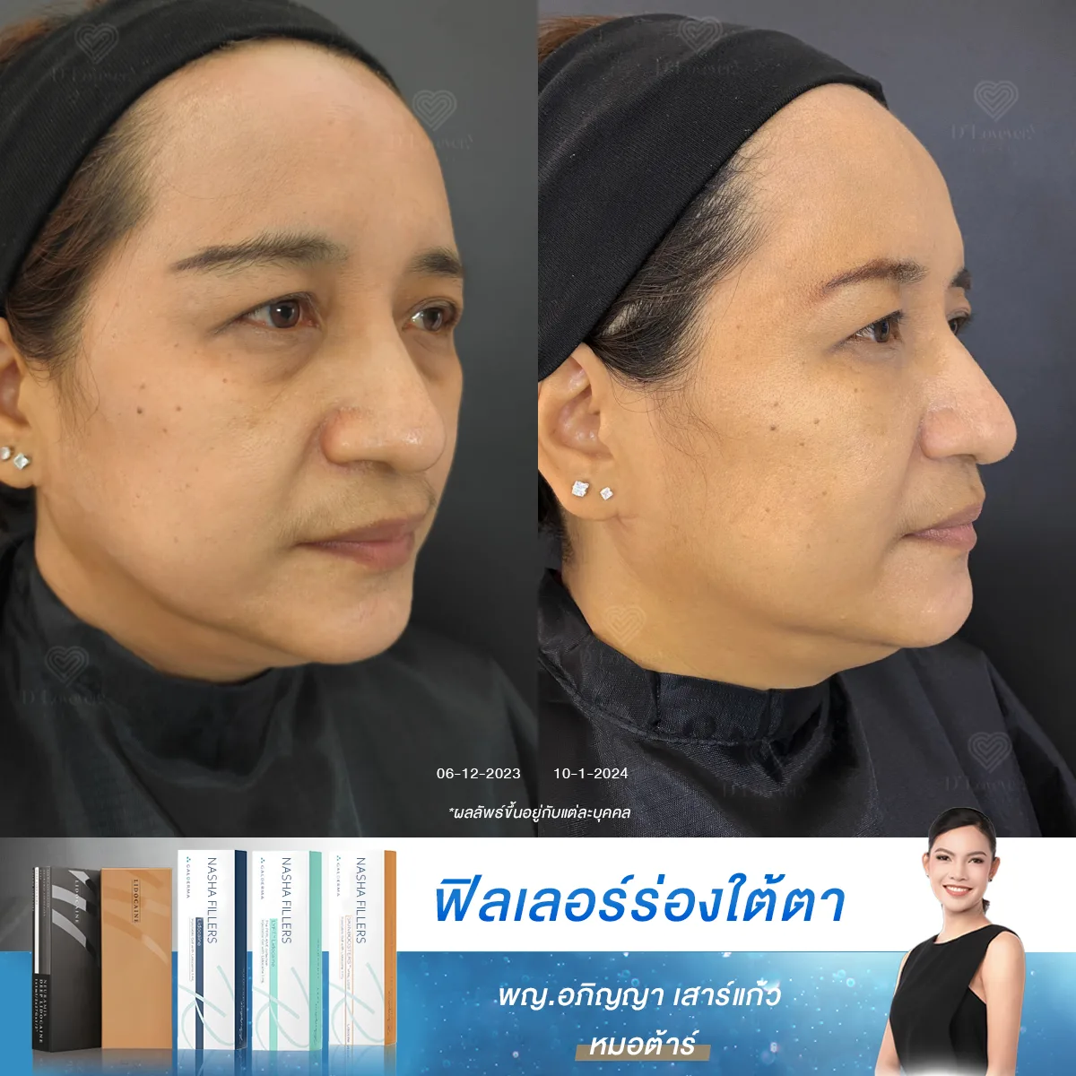 ใต้ตาลึก ร่องชัด ต้องแก้! รีวิวการเติมฟิลเลอร์ที่คนกลัวเข็มยังกล้าทำ