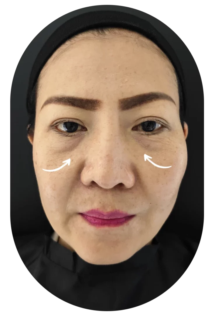 Under-eye filler before-and-after portrait of woman with arrows indicating treatment area