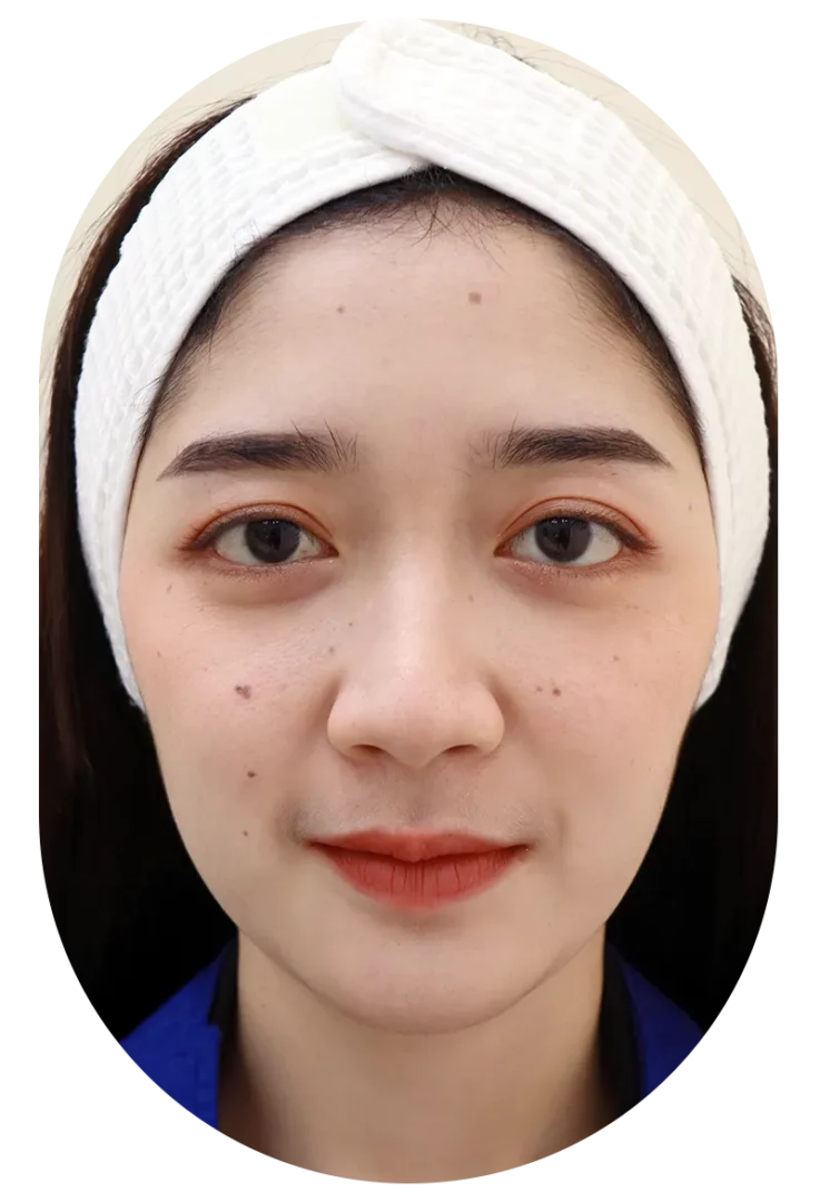 Case 73 Face After Co2 Laser Mole Removal Portrait