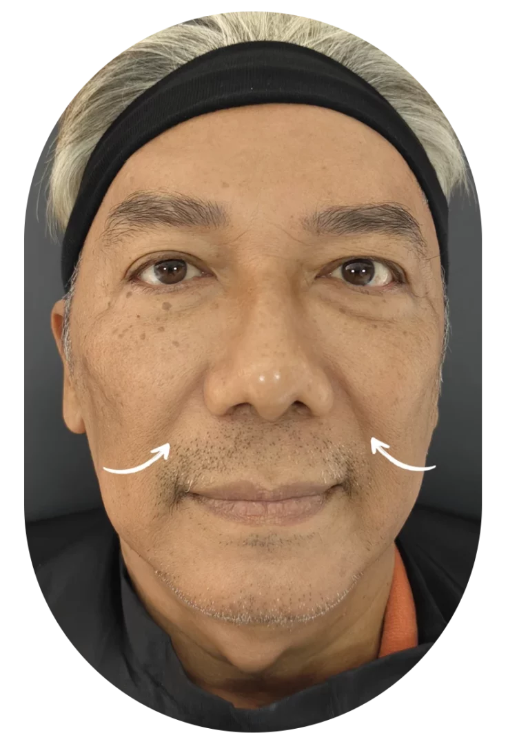 Nasolabial fold filler and mole removal patient portrait