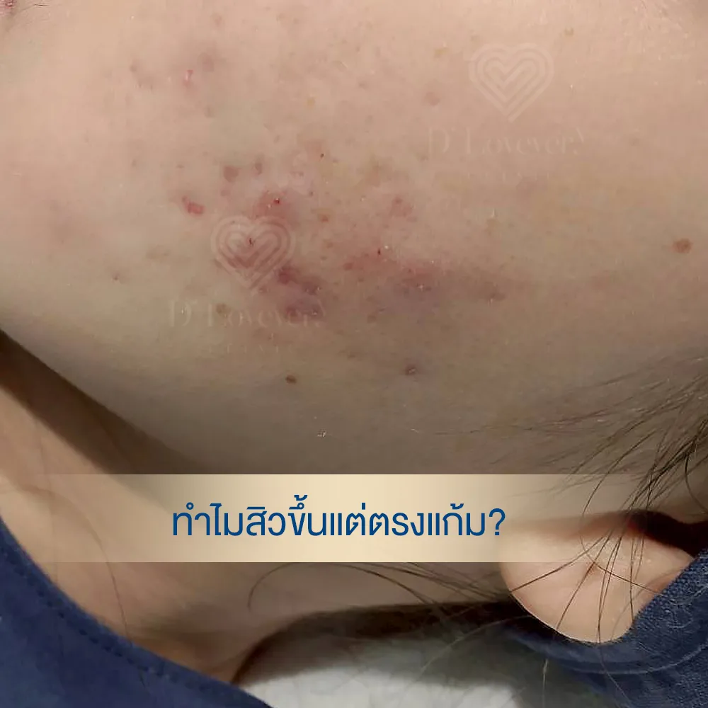 Close-up of cheek acne showing red papules, pustules, scabs, and dark spots