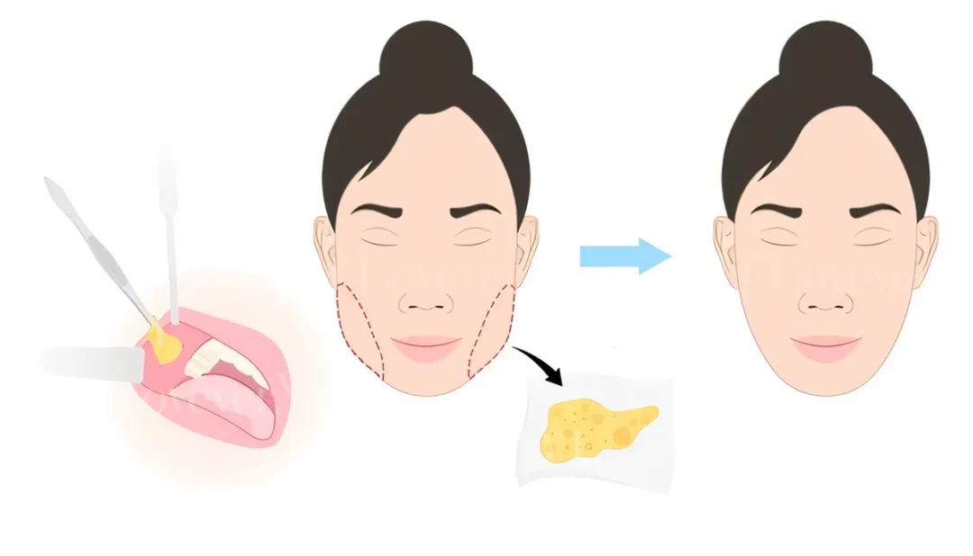 cheek-buccal-fat-removal-augment-dlovevery-clinic