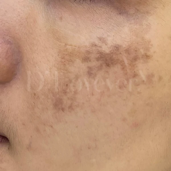 Close-up of cheek hyperpigmentation: brown dark spots, freckling, uneven skin texture