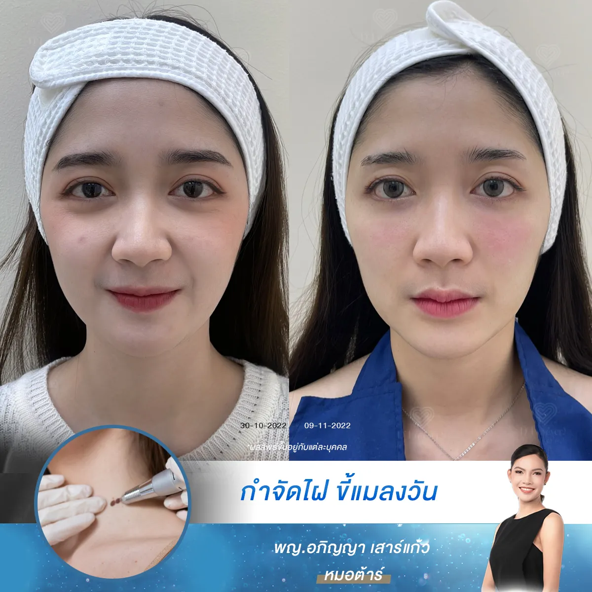 Co Laser Mole Before After Case 73 2
