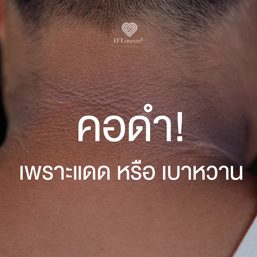 Dark neck hyperpigmentation close-up: sun damage or diabetes?