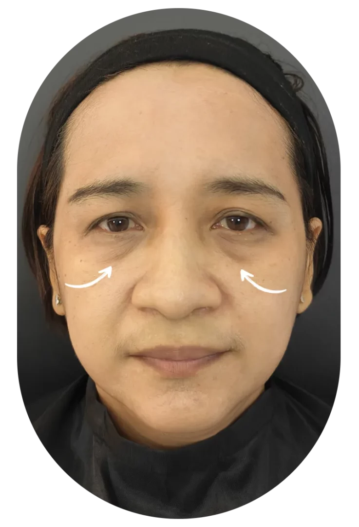 Clinical before photo: tear trough filler for dark under-eye circles