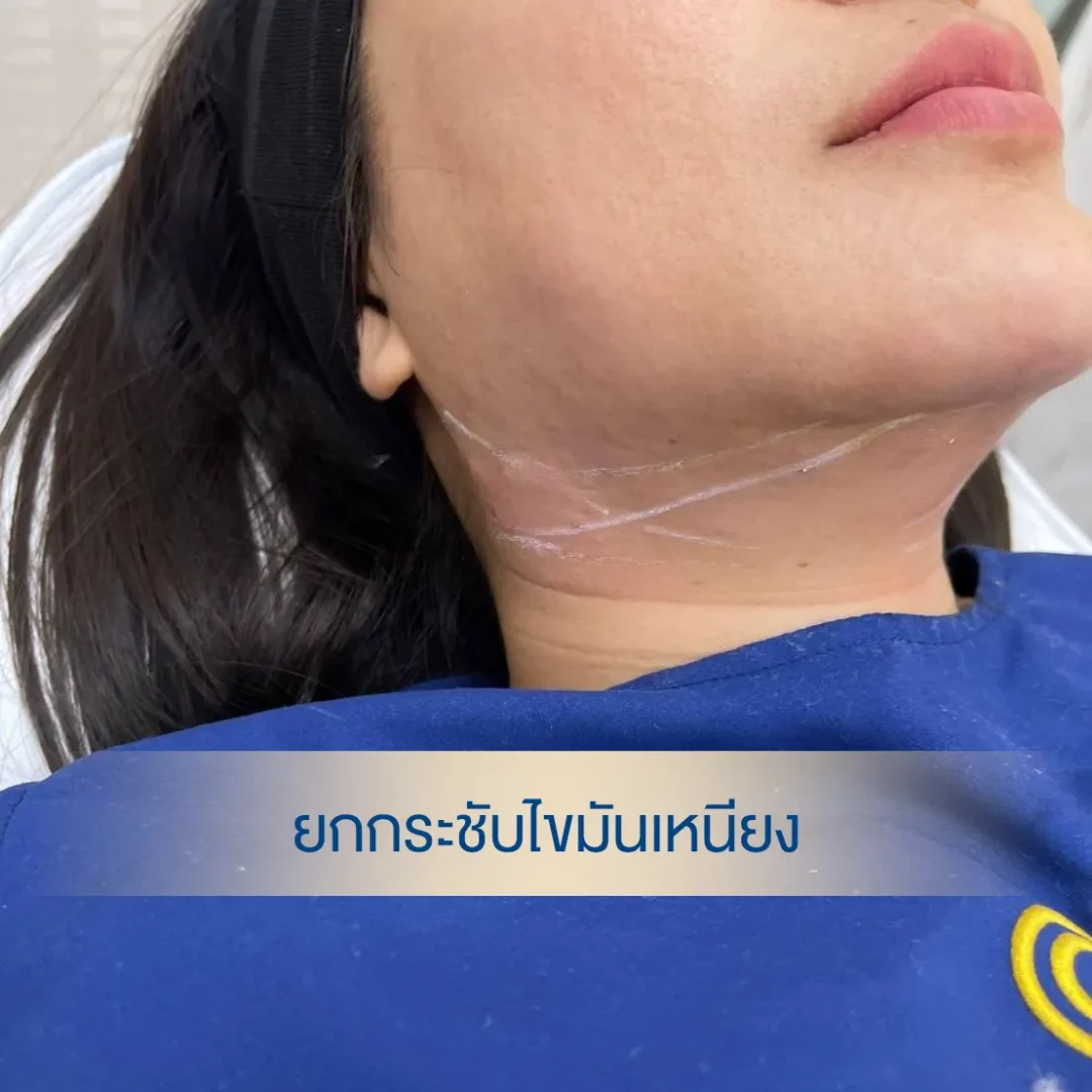 Làn da mịn màng hơn với Rejuran - Rejuran làm căng da và săn chắc vùng cằm bằng công nghệ Hifu.