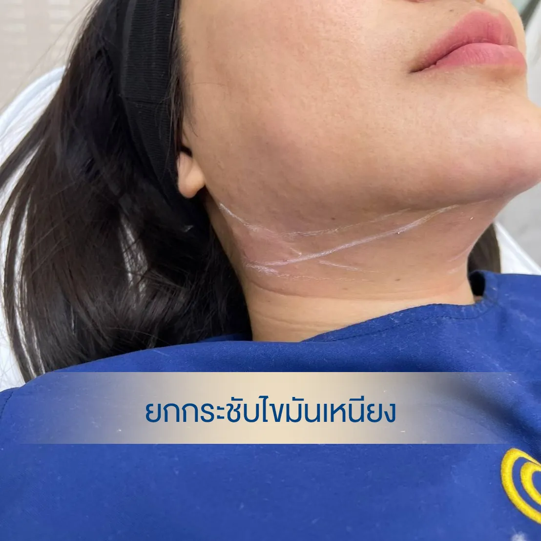 HIFU double-chin before photo — patient profile with pre-treatment submental markings