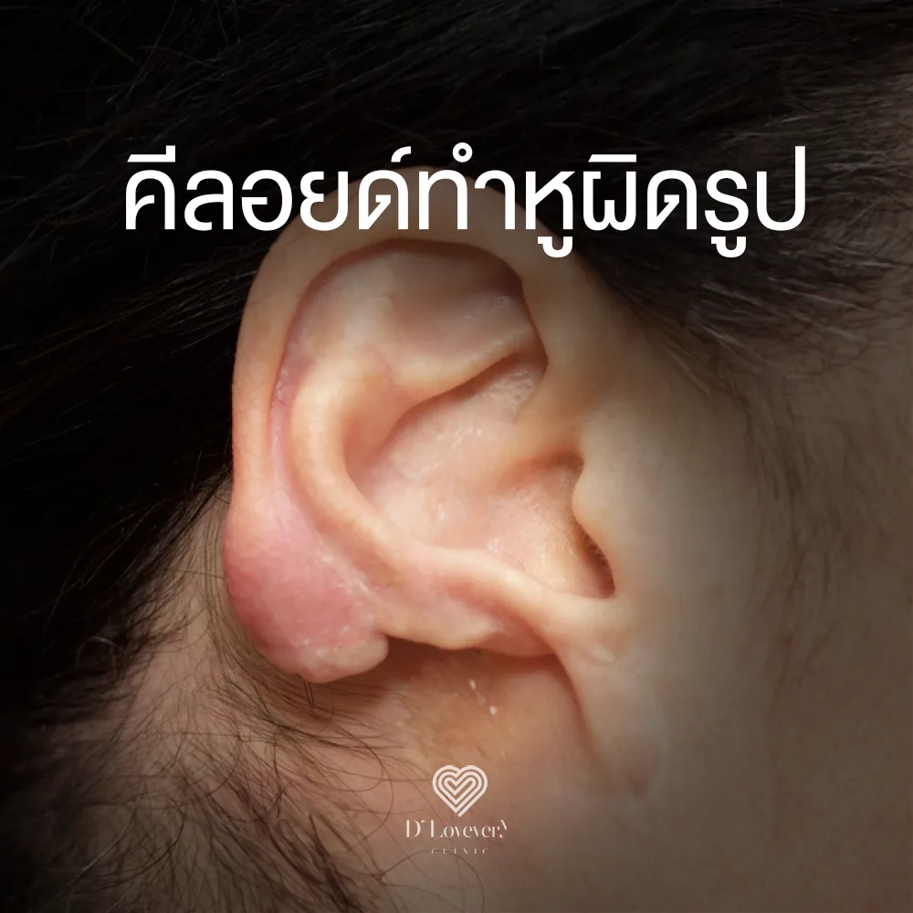 Swollen earlobe keloid causing visible ear deformity