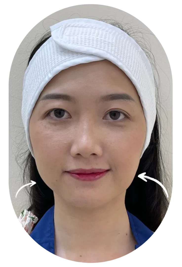 Real patient jawline enhancement review portrait with highlighted jawline