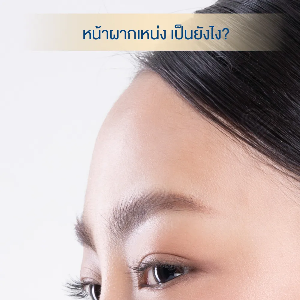 Flat forehead close-up for forehead filler treatment