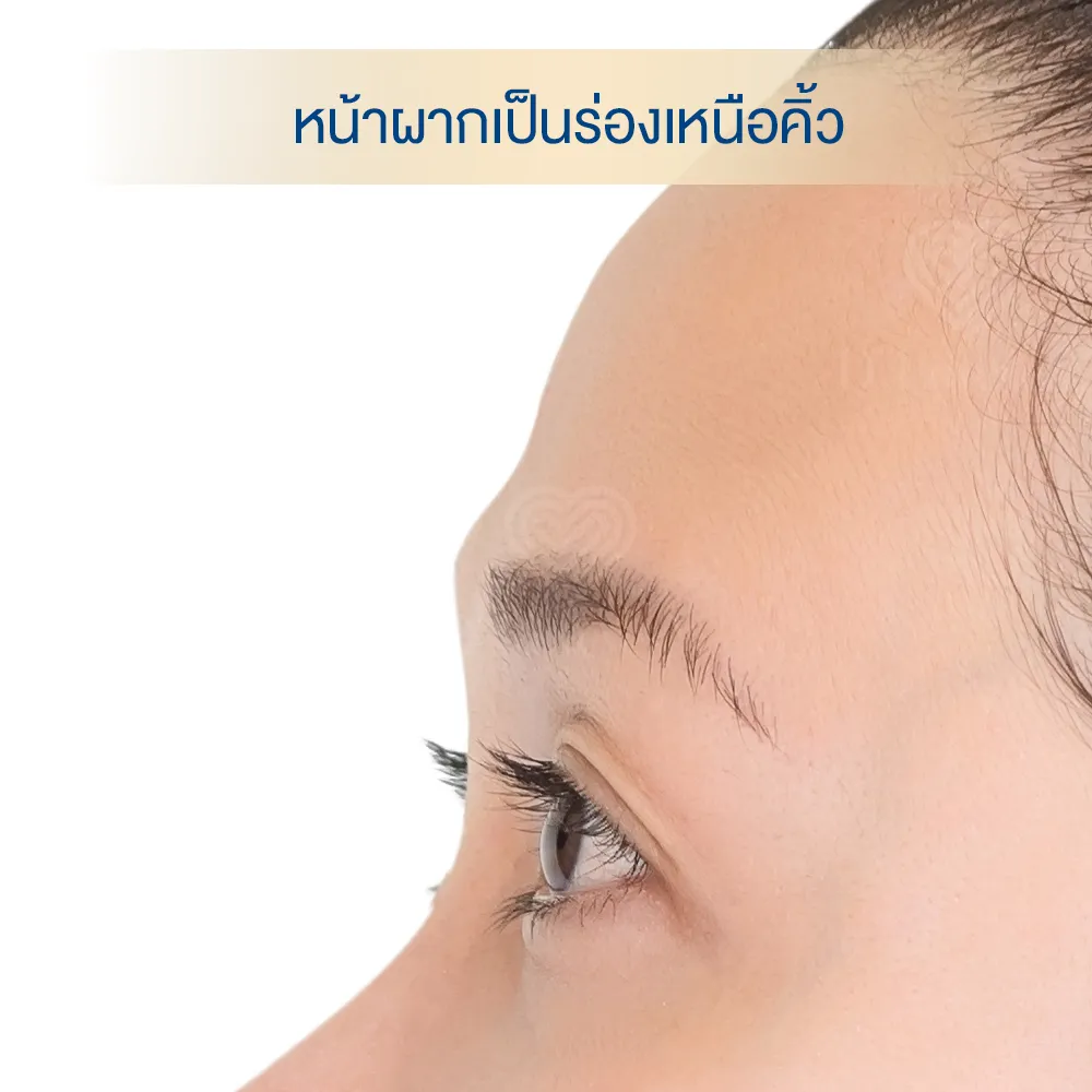 หน้าผากเป็นร่อง บุ๋ม เหนือคิ้ว ไม่เรียบ ทำยังไงดี dlovevery clinic
