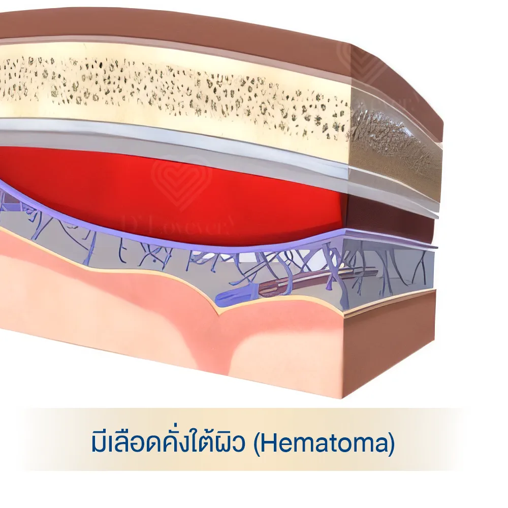 Subcutaneous hematoma cross-section anatomy diagram showing blood collection beneath skin compressing tissues