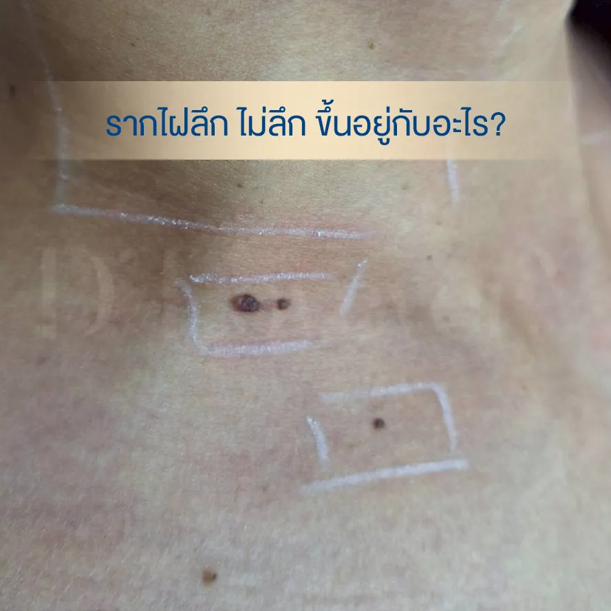 Mole depth: close-up chest skin with outlined pigmented moles