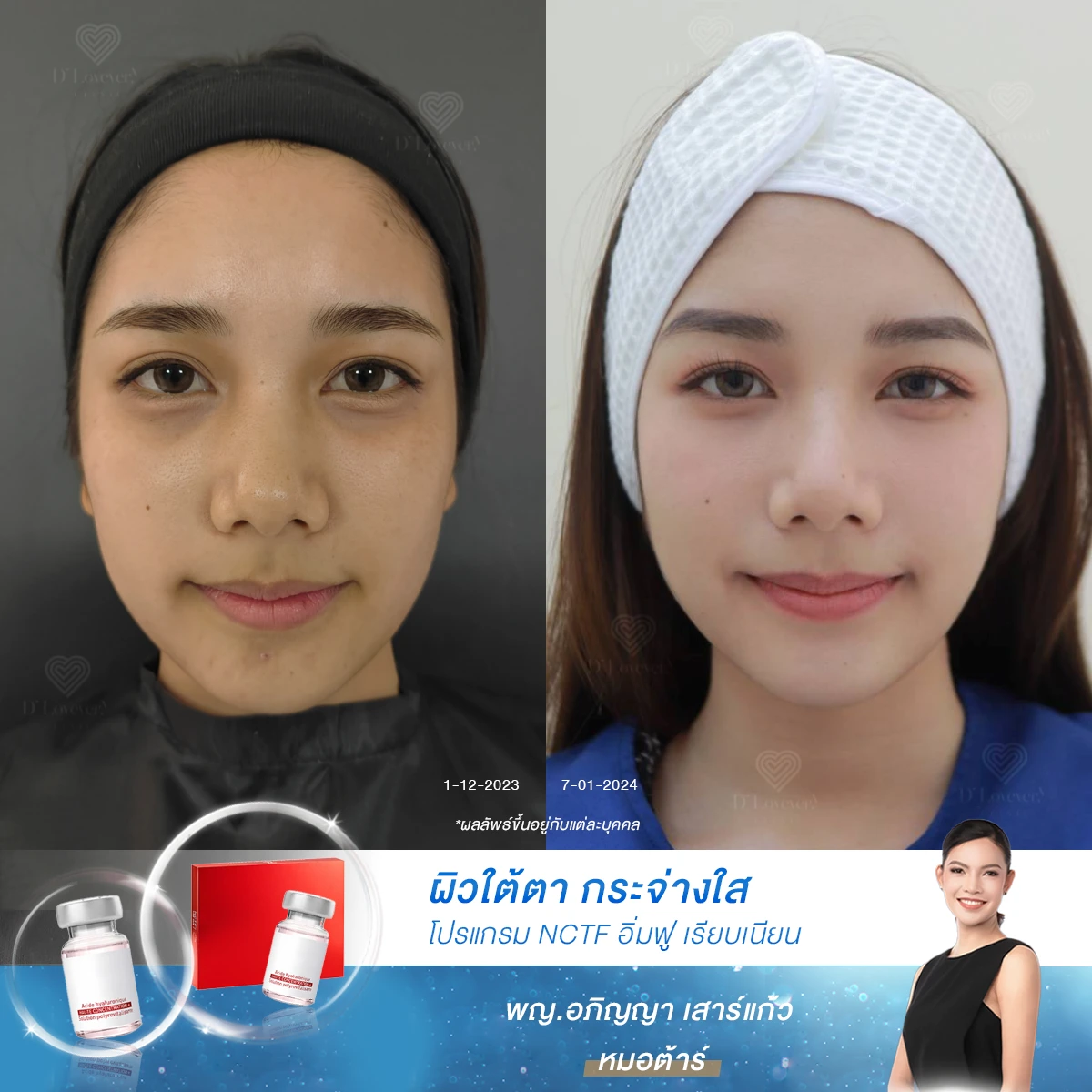[รีวิวฉีดวิตามินใต้ตา] สาววัยใส กิจกรรมเยอะ นอนดึกแทบทุกวัน ขอบตาคล้ำเกินต้านไหว โปรแกรมนี้ช่วยได้