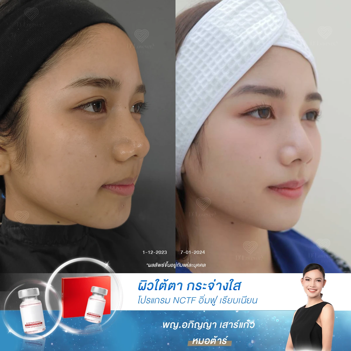 ความมั่นใจ-หลังฉีดnctf