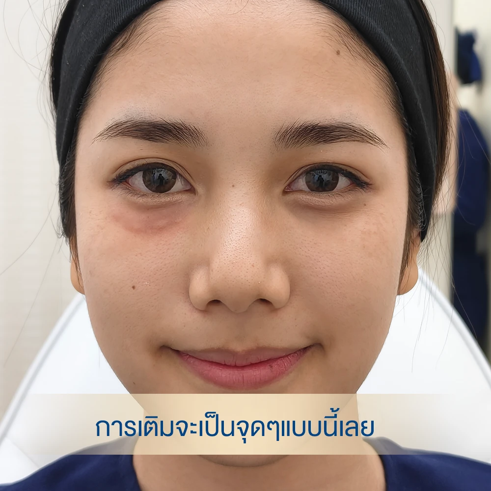 ขั้นตอนฉีดผิว-โปรแกรมnctf dlovevery clinic