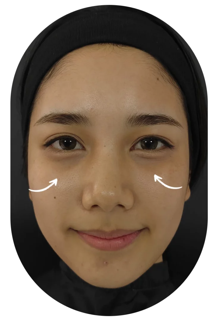 NCTF 135HA under-eye treatment review — clinic patient close-up highlighting under-eye area