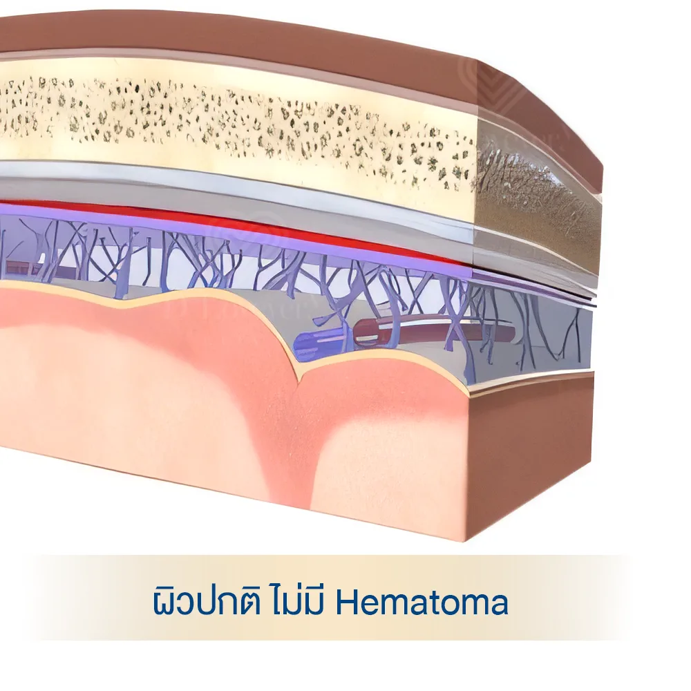 Normal skin cross-section showing subcutaneous layers, vasculature and underlying bone, no hematoma