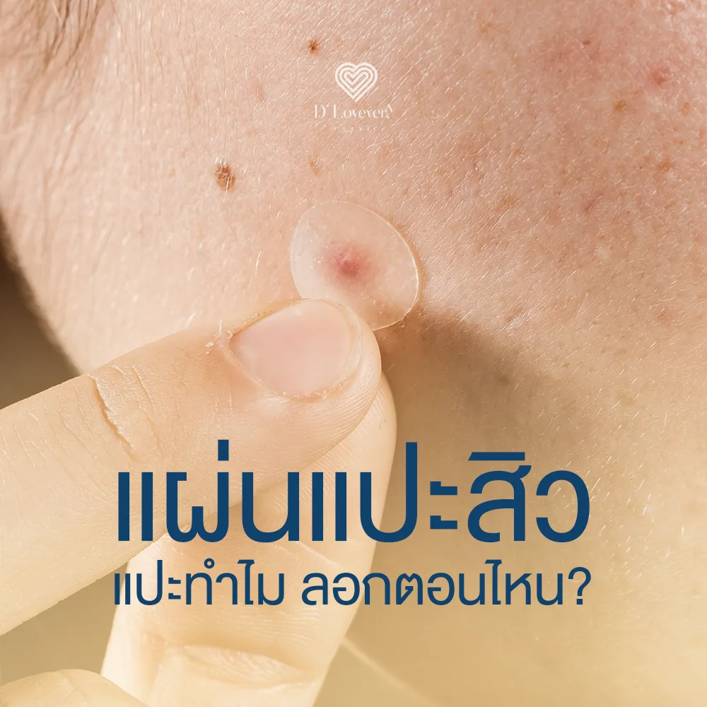 Pimple patch on facial skin being applied by fingertip—acne patch use and removal