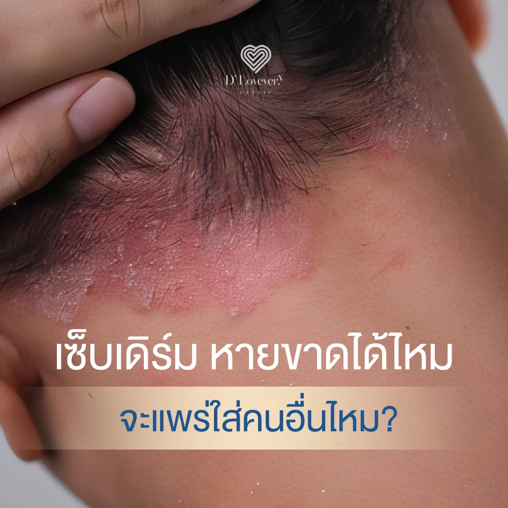 Close-up of seborrheic dermatitis on scalp and nape: red scaly patches and flakes