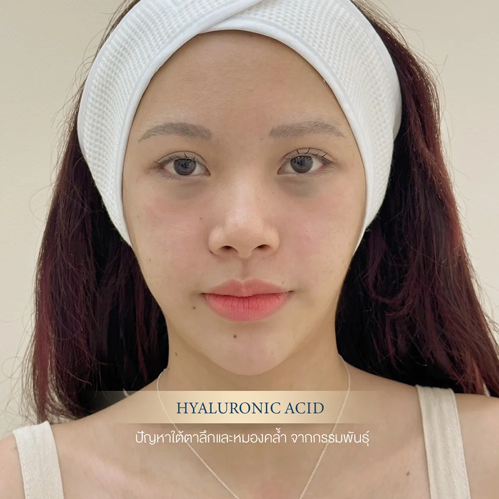 Hyaluronic acid under-eye dark circles clinic portrait of young woman