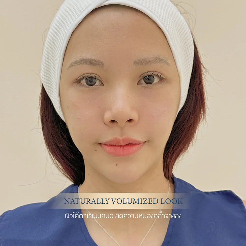 Under-eye filler results, natural clinical headshot of woman