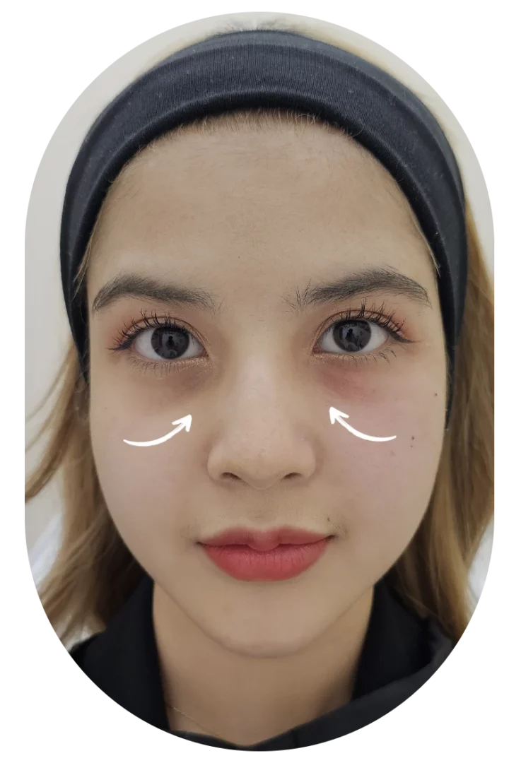 Tear trough pre-treatment under-eye filler portrait highlighting hollows and discoloration