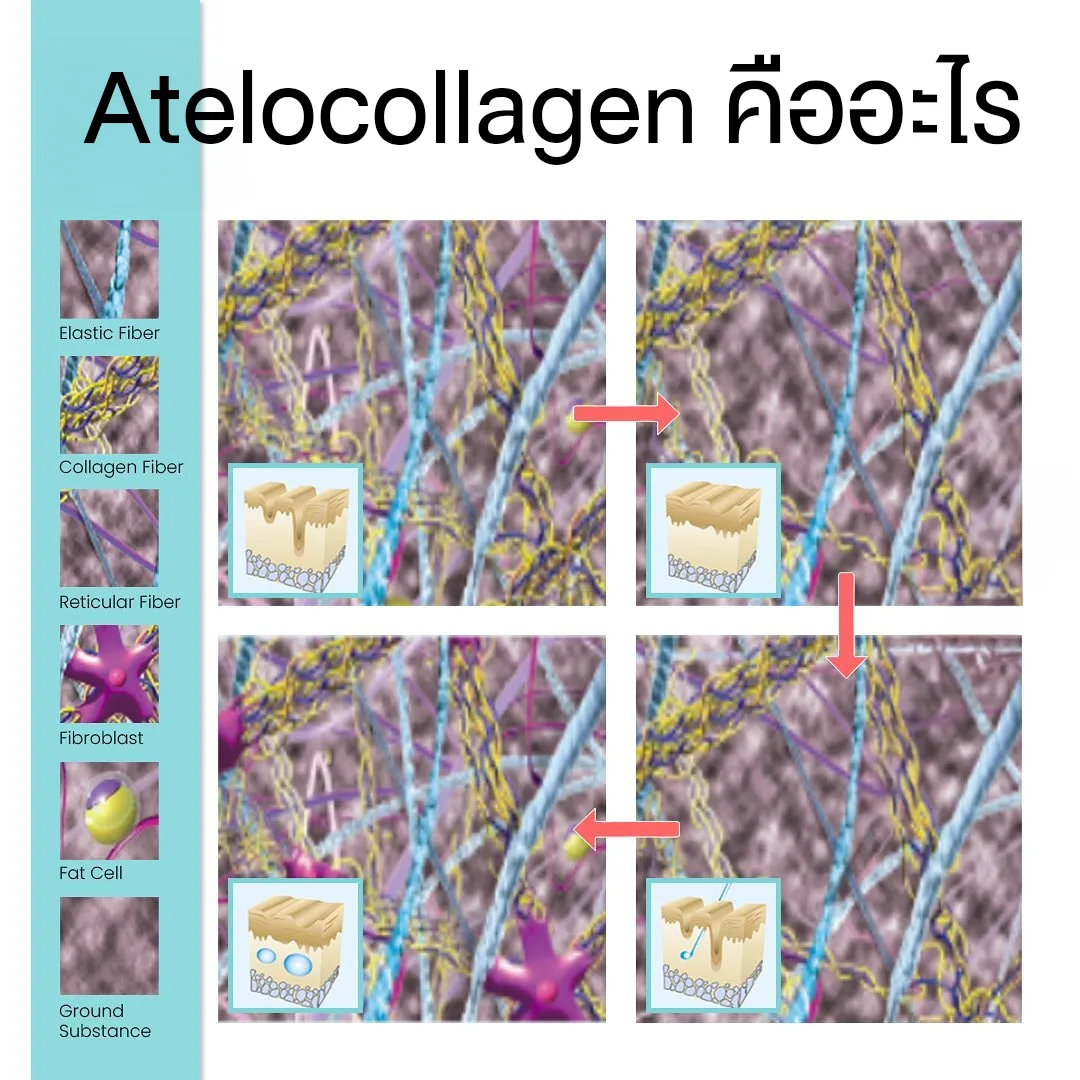 Atelocollagen infographic illustrating collagen, elastic, and reticular fibers in connective tissue