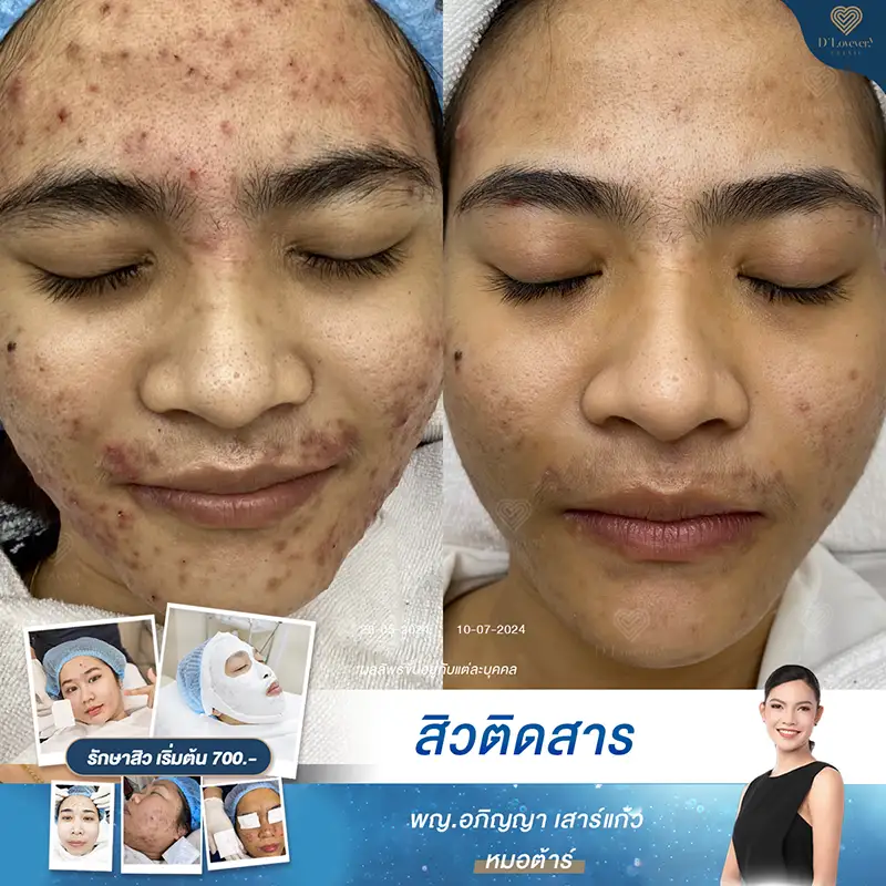 [รีวิวกู้หน้า] พลาดกับครีมสเตียรอยด์แค่ครั้งเดียว หน้าอาจพังแบบนี้ได้