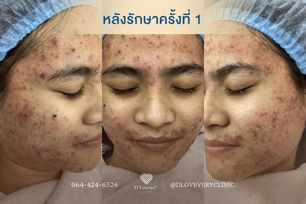 สิวอักเสบกับสิวธรรมดาต่างกันยังไง ต้องดูแลแบบพิเศษไหม?